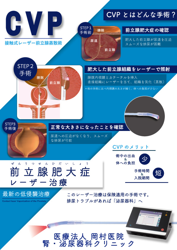 接触式レーザー前立腺蒸散術