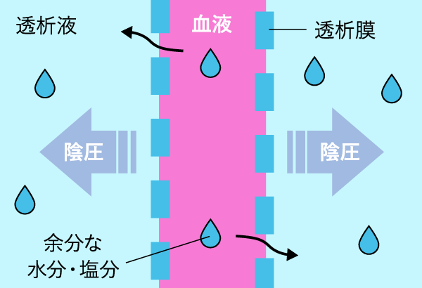 HD限外濾過イメージ